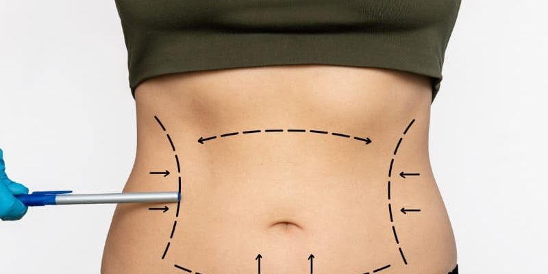 abdominoplastia-com-lipoaspiracao-entenda abdominoplastia-com-lipoaspiracao-entenda